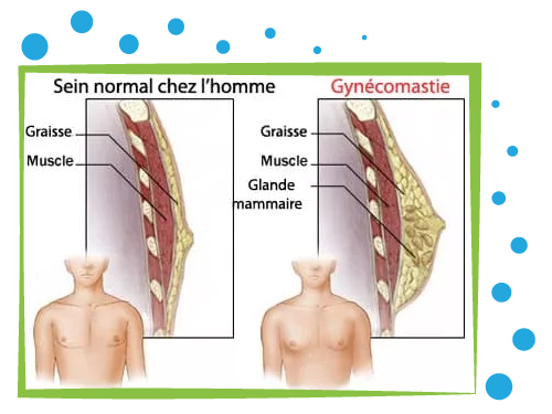 definition Gynécomastie