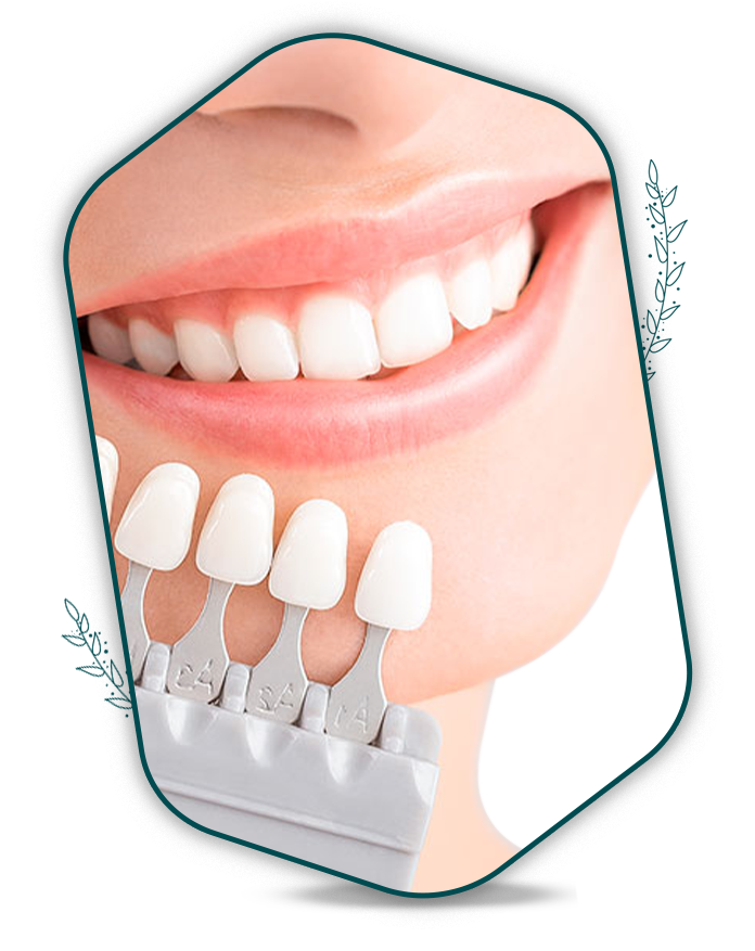 facettes dentaires devis en ligne