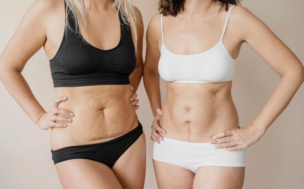 Abdominoplastie après grossesse : Redéfinir votre corps et votre confiance