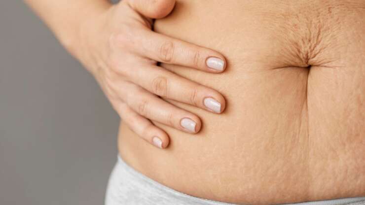 Diastase abdominale femme : que faire ?