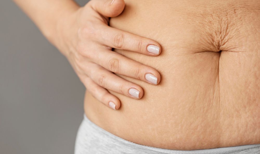 Diastase abdominale femme : que faire ?