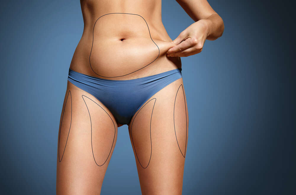 Liposuccion laser : sculptez votre silhouette à prix doux en Tunisie