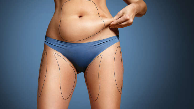 Liposuccion laser : sculptez votre silhouette à prix doux en Tunisie