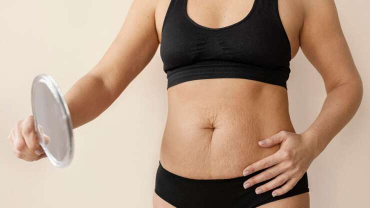 Bodylift après sleeve en Tunisie pour une totale transformation