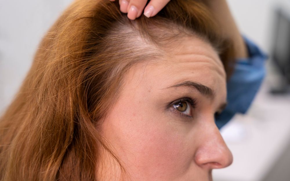 Implant cheveux femme en Tunisie pour retrouver un belle chevelure !