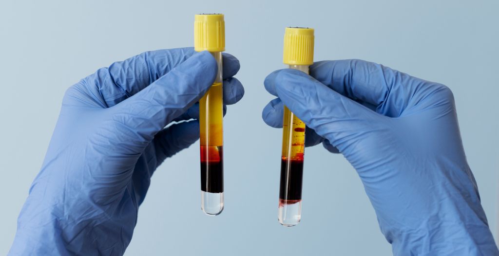 injection platelet rich plasma prp tunisie