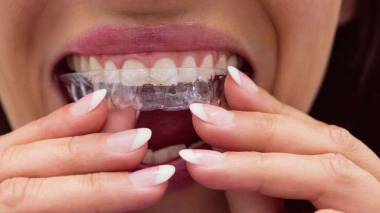 Invisalign en Tunisie : L’alternative discrète pour un sourire parfait