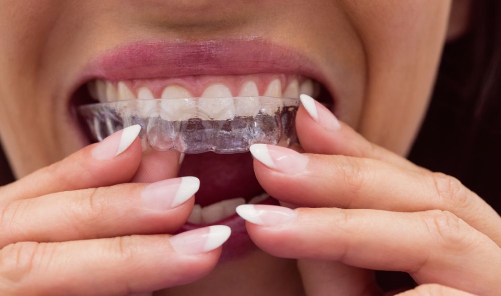 Invisalign en Tunisie : L’alternative discrète pour un sourire parfait