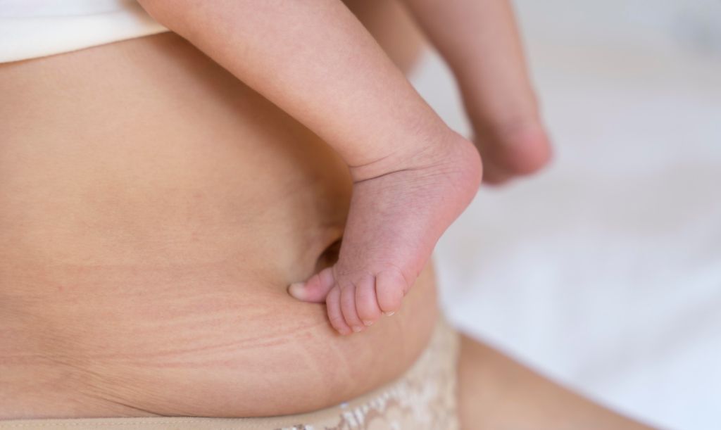 abdominoplastie après césarienne en tunisie