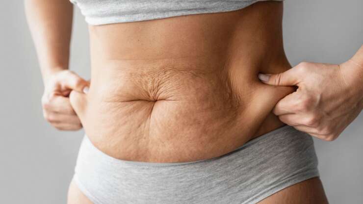 Excès de peau : Causes et solutions efficaces