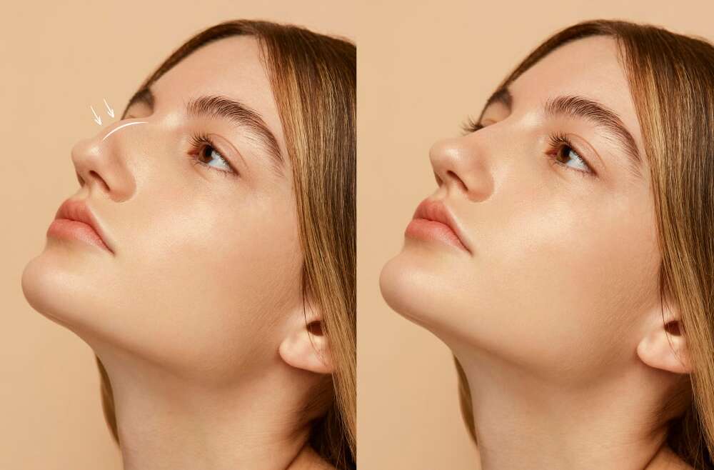 Nez Asymétrique : Causes, Conséquences et Solutions Esthétiques